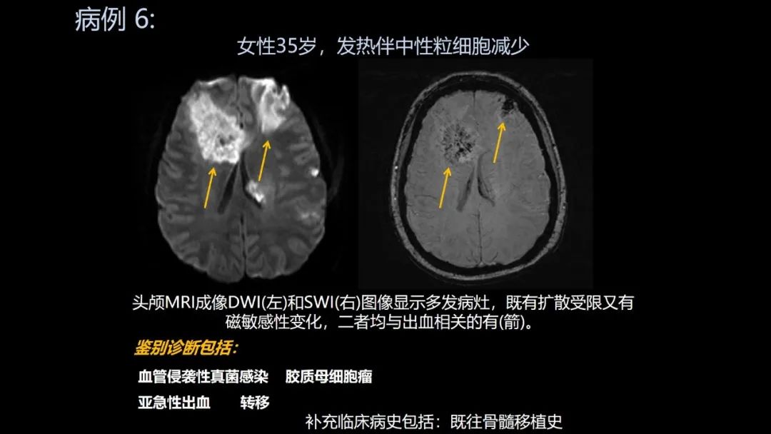 影像PPT - 【PPT】共通之处:同时累及中枢神经系统和心肺系统的疾病-35 影像PPT - 【PPT】共通之处:同时累及中枢神经系统和心肺系统的疾病-35