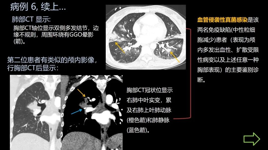 影像PPT - 【PPT】共通之处:同时累及中枢神经系统和心肺系统的疾病-37 影像PPT - 【PPT】共通之处:同时累及中枢神经系统和心肺系统的疾病-37