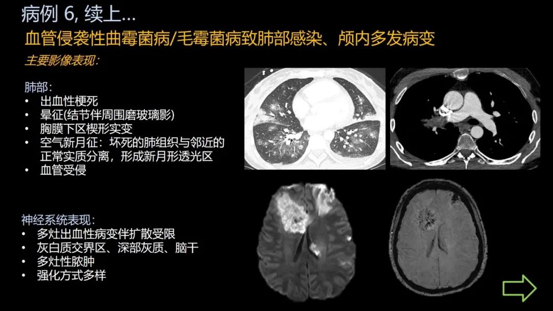 影像PPT - 【PPT】共通之处:同时累及中枢神经系统和心肺系统的疾病-39 影像PPT - 【PPT】共通之处:同时累及中枢神经系统和心肺系统的疾病-39
