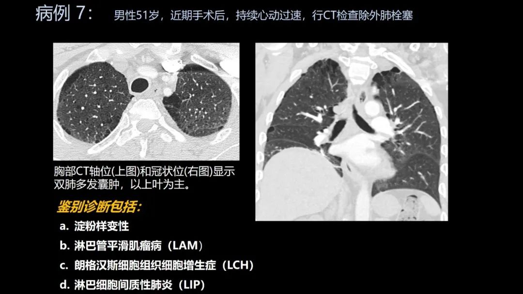 影像PPT - 【PPT】共通之处:同时累及中枢神经系统和心肺系统的疾病-41 影像PPT - 【PPT】共通之处:同时累及中枢神经系统和心肺系统的疾病-41
