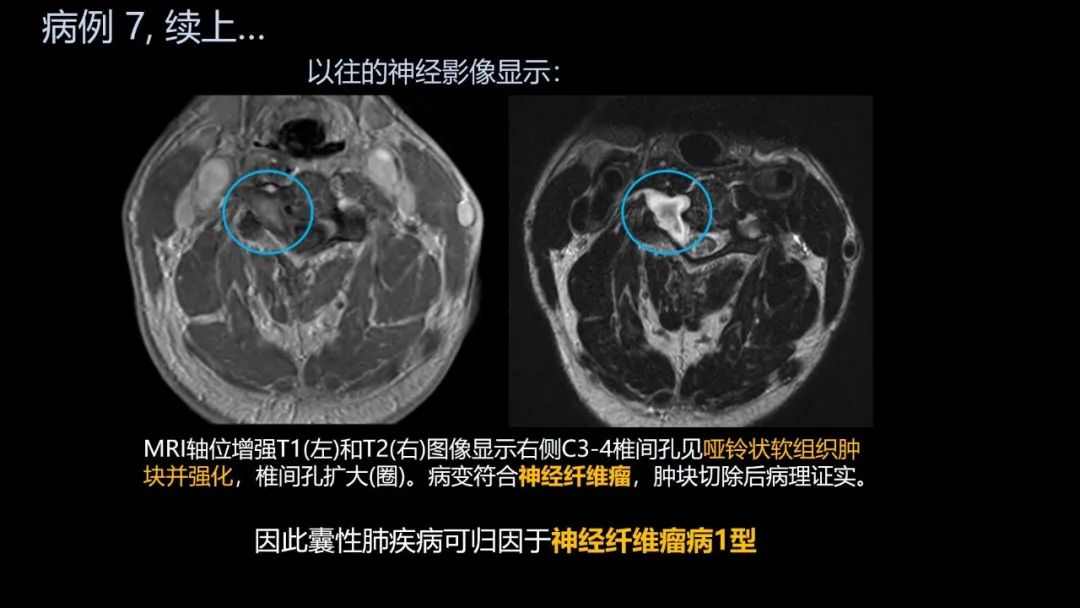 影像PPT - 【PPT】共通之处:同时累及中枢神经系统和心肺系统的疾病-43 影像PPT - 【PPT】共通之处:同时累及中枢神经系统和心肺系统的疾病-43