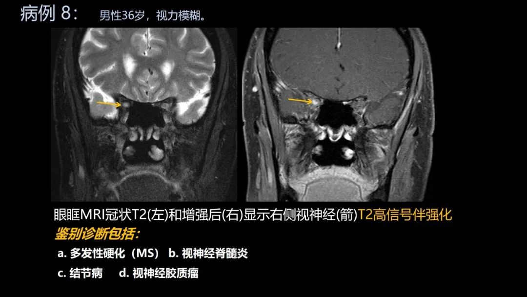 影像PPT - 【PPT】共通之处:同时累及中枢神经系统和心肺系统的疾病-47 影像PPT - 【PPT】共通之处:同时累及中枢神经系统和心肺系统的疾病-47