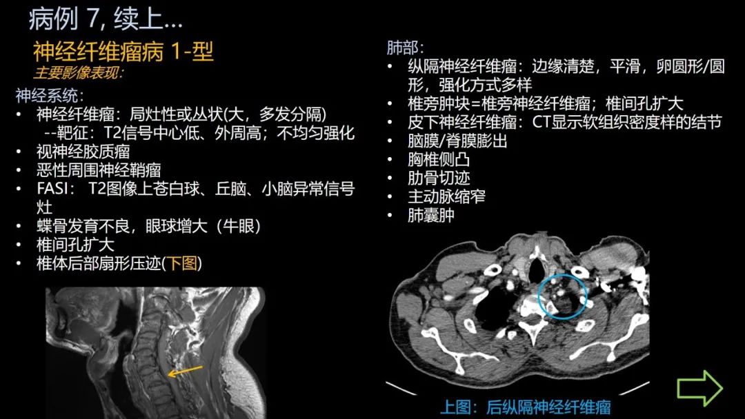 影像PPT - 【PPT】共通之处:同时累及中枢神经系统和心肺系统的疾病-45 影像PPT - 【PPT】共通之处:同时累及中枢神经系统和心肺系统的疾病-45