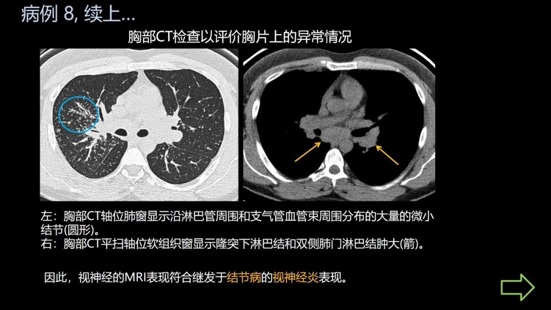 影像PPT - 【PPT】共通之处:同时累及中枢神经系统和心肺系统的疾病-49 影像PPT - 【PPT】共通之处:同时累及中枢神经系统和心肺系统的疾病-49