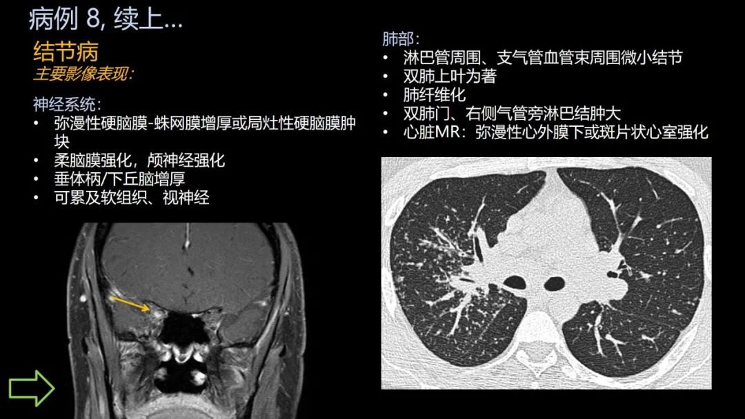 影像PPT - 【PPT】共通之处:同时累及中枢神经系统和心肺系统的疾病-51 影像PPT - 【PPT】共通之处:同时累及中枢神经系统和心肺系统的疾病-51