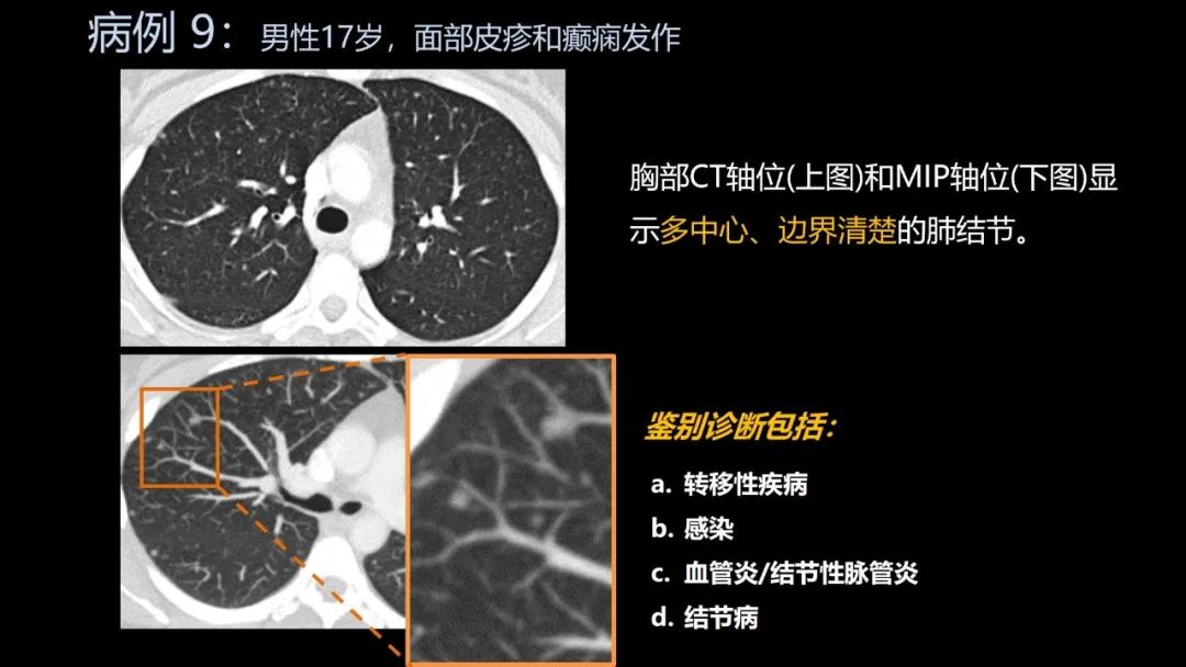 影像PPT - 【PPT】共通之处:同时累及中枢神经系统和心肺系统的疾病-53 影像PPT - 【PPT】共通之处:同时累及中枢神经系统和心肺系统的疾病-53