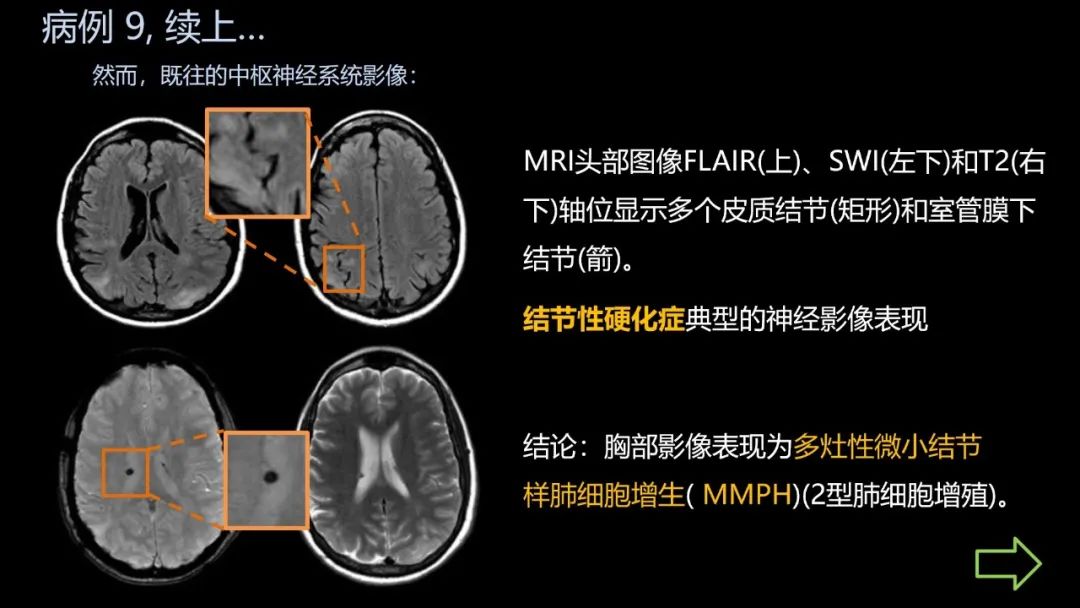 影像PPT - 【PPT】共通之处:同时累及中枢神经系统和心肺系统的疾病-55 影像PPT - 【PPT】共通之处:同时累及中枢神经系统和心肺系统的疾病-55