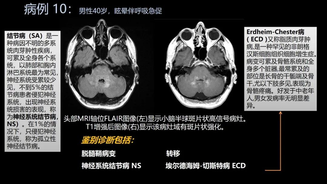 影像PPT - 【PPT】共通之处:同时累及中枢神经系统和心肺系统的疾病-59 影像PPT - 【PPT】共通之处:同时累及中枢神经系统和心肺系统的疾病-59