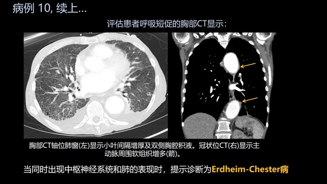 影像PPT - 【PPT】共通之处:同时累及中枢神经系统和心肺系统的疾病-61 影像PPT - 【PPT】共通之处:同时累及中枢神经系统和心肺系统的疾病-61