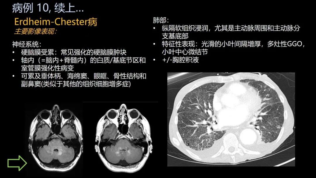影像PPT - 【PPT】共通之处:同时累及中枢神经系统和心肺系统的疾病-63 影像PPT - 【PPT】共通之处:同时累及中枢神经系统和心肺系统的疾病-63