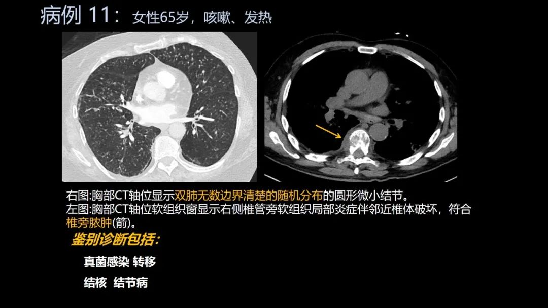 影像PPT - 【PPT】共通之处:同时累及中枢神经系统和心肺系统的疾病-65 影像PPT - 【PPT】共通之处:同时累及中枢神经系统和心肺系统的疾病-65