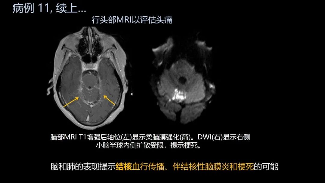 影像PPT - 【PPT】共通之处:同时累及中枢神经系统和心肺系统的疾病-67 影像PPT - 【PPT】共通之处:同时累及中枢神经系统和心肺系统的疾病-67