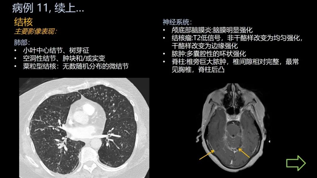 影像PPT - 【PPT】共通之处:同时累及中枢神经系统和心肺系统的疾病-69 影像PPT - 【PPT】共通之处:同时累及中枢神经系统和心肺系统的疾病-69