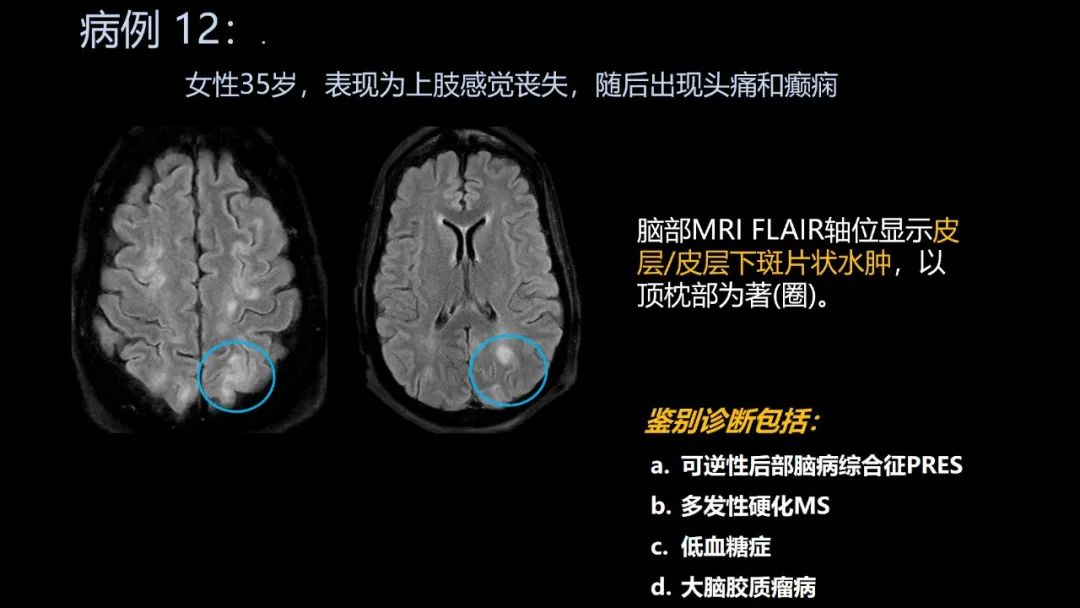 影像PPT - 【PPT】共通之处:同时累及中枢神经系统和心肺系统的疾病-71 影像PPT - 【PPT】共通之处:同时累及中枢神经系统和心肺系统的疾病-71