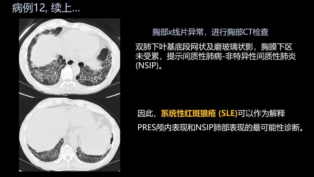 影像PPT - 【PPT】共通之处:同时累及中枢神经系统和心肺系统的疾病-73 影像PPT - 【PPT】共通之处:同时累及中枢神经系统和心肺系统的疾病-73