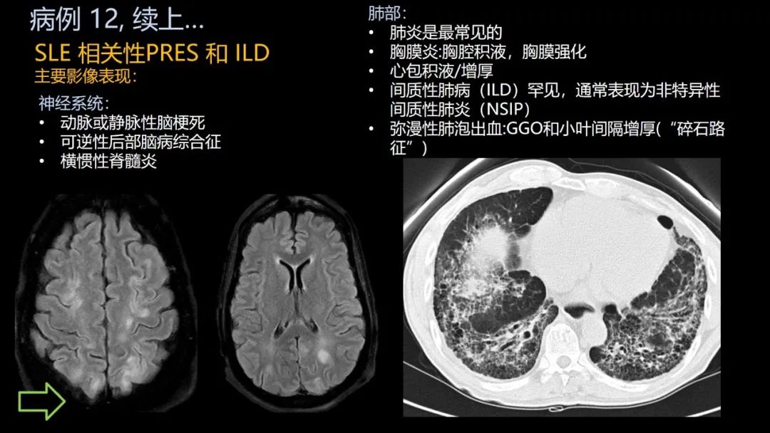 影像PPT - 【PPT】共通之处:同时累及中枢神经系统和心肺系统的疾病-75 影像PPT - 【PPT】共通之处:同时累及中枢神经系统和心肺系统的疾病-75
