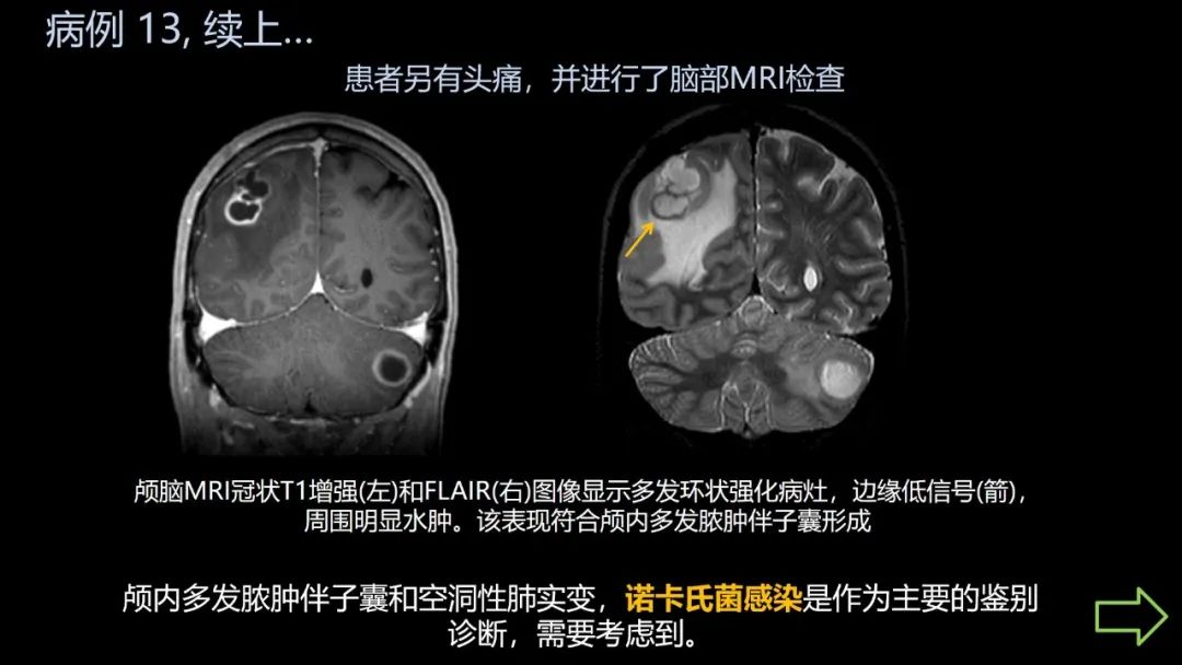 影像PPT - 【PPT】共通之处:同时累及中枢神经系统和心肺系统的疾病-79 影像PPT - 【PPT】共通之处:同时累及中枢神经系统和心肺系统的疾病-79
