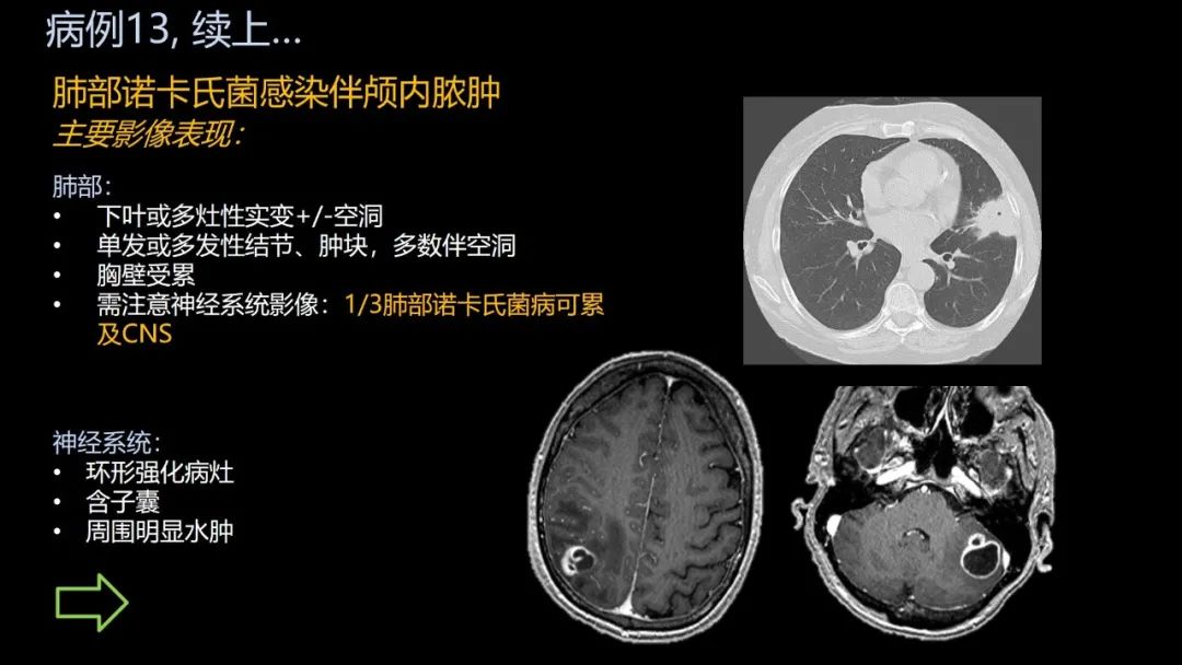 影像PPT - 【PPT】共通之处:同时累及中枢神经系统和心肺系统的疾病-81 影像PPT - 【PPT】共通之处:同时累及中枢神经系统和心肺系统的疾病-81