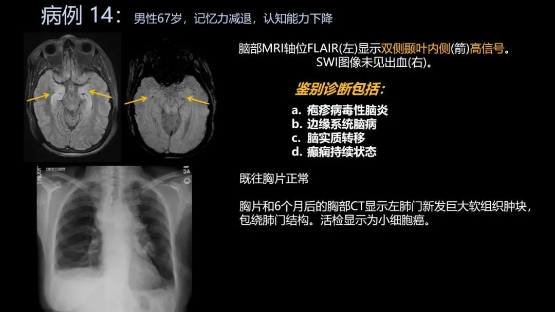 影像PPT - 【PPT】共通之处:同时累及中枢神经系统和心肺系统的疾病-83 影像PPT - 【PPT】共通之处:同时累及中枢神经系统和心肺系统的疾病-83