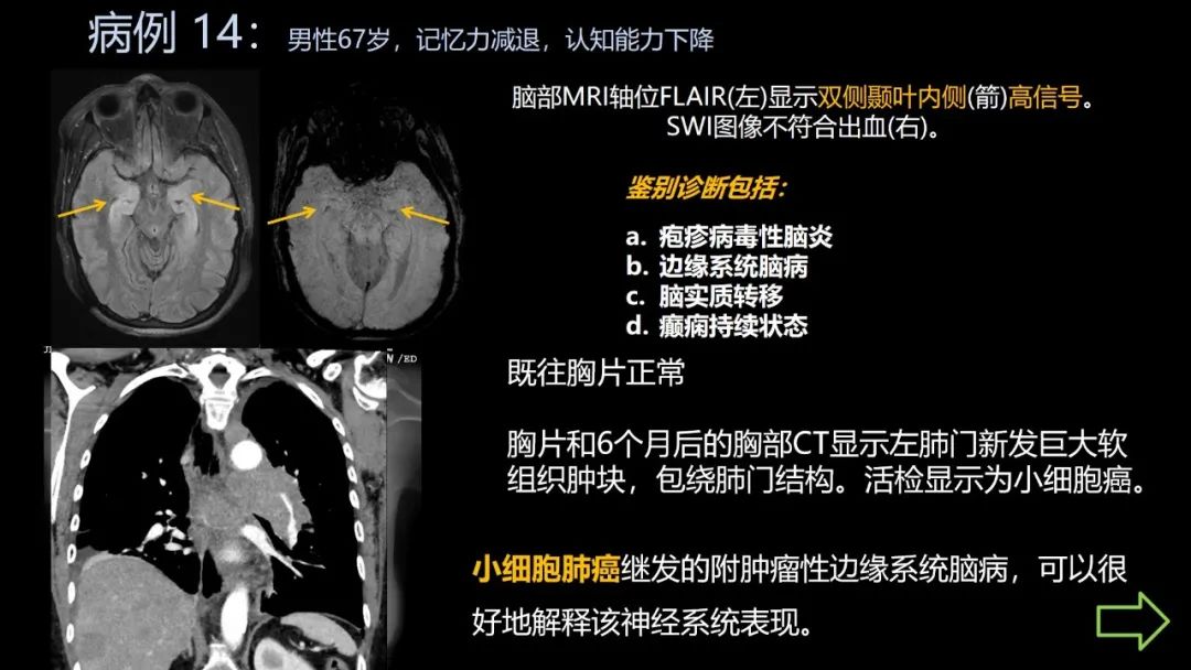 影像PPT - 【PPT】共通之处:同时累及中枢神经系统和心肺系统的疾病-85 影像PPT - 【PPT】共通之处:同时累及中枢神经系统和心肺系统的疾病-85