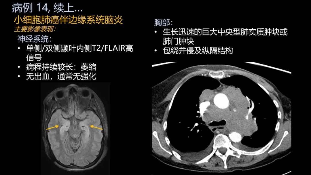 影像PPT - 【PPT】共通之处:同时累及中枢神经系统和心肺系统的疾病-87 影像PPT - 【PPT】共通之处:同时累及中枢神经系统和心肺系统的疾病-87