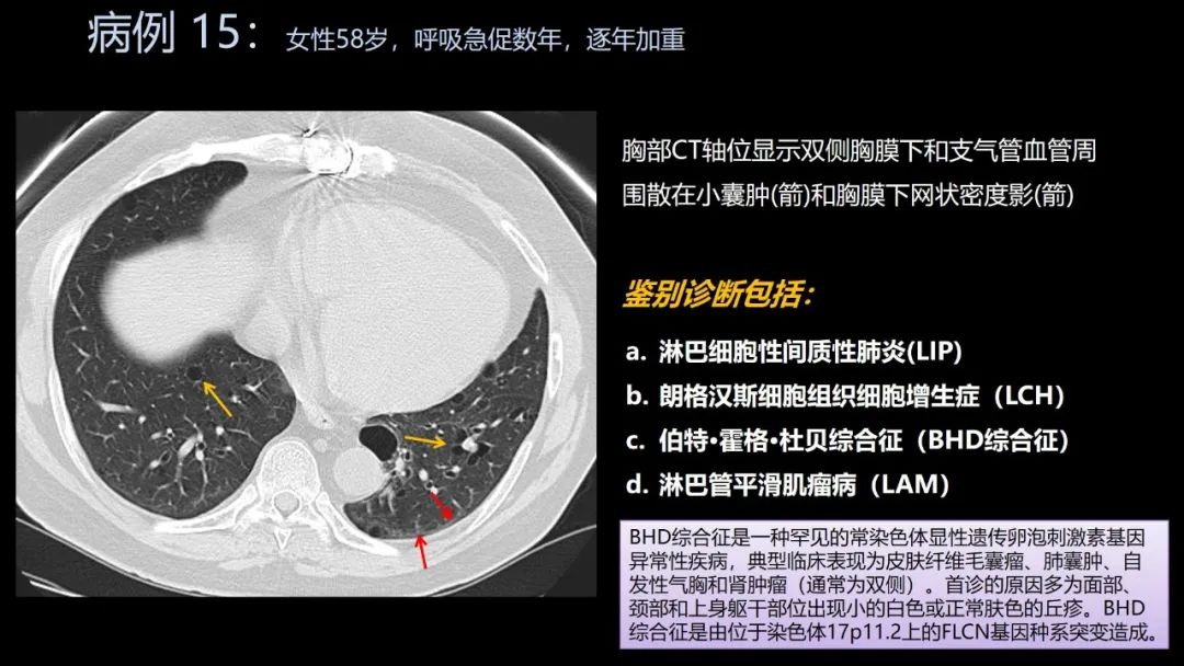 影像PPT - 【PPT】共通之处:同时累及中枢神经系统和心肺系统的疾病-89 影像PPT - 【PPT】共通之处:同时累及中枢神经系统和心肺系统的疾病-89