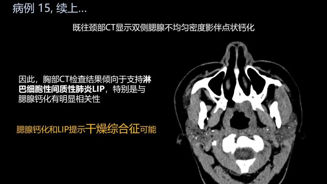 影像PPT - 【PPT】共通之处:同时累及中枢神经系统和心肺系统的疾病-91 影像PPT - 【PPT】共通之处:同时累及中枢神经系统和心肺系统的疾病-91