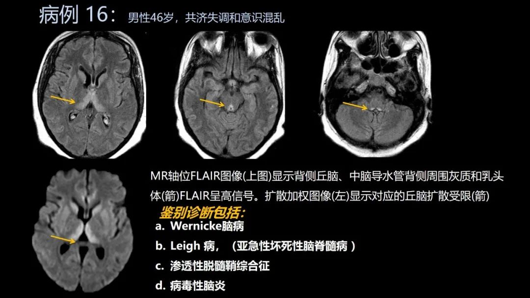 影像PPT - 【PPT】共通之处:同时累及中枢神经系统和心肺系统的疾病-95 影像PPT - 【PPT】共通之处:同时累及中枢神经系统和心肺系统的疾病-95