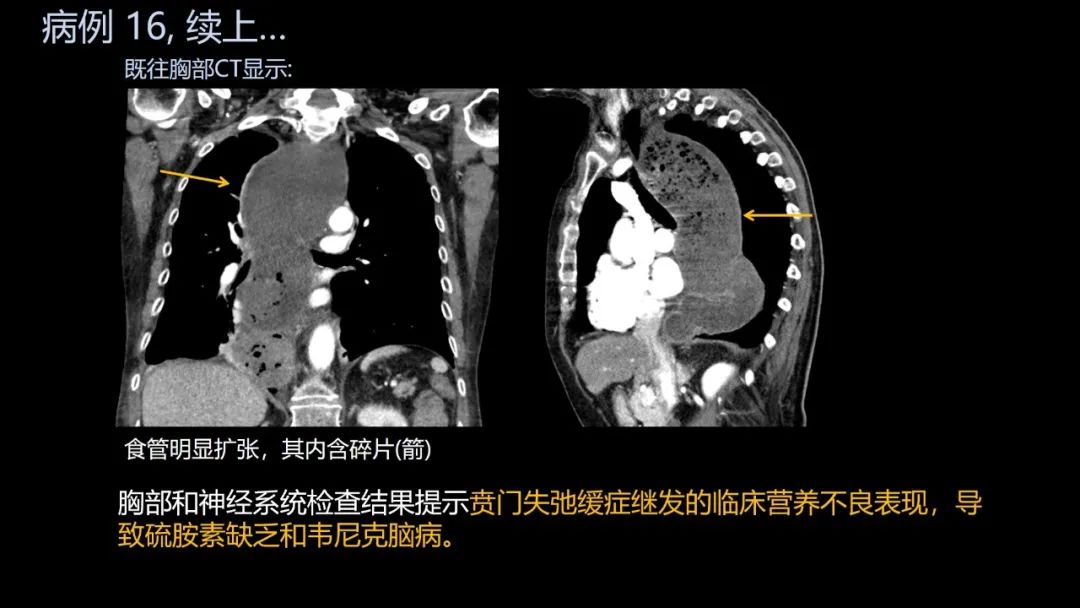 影像PPT - 【PPT】共通之处:同时累及中枢神经系统和心肺系统的疾病-97 影像PPT - 【PPT】共通之处:同时累及中枢神经系统和心肺系统的疾病-97