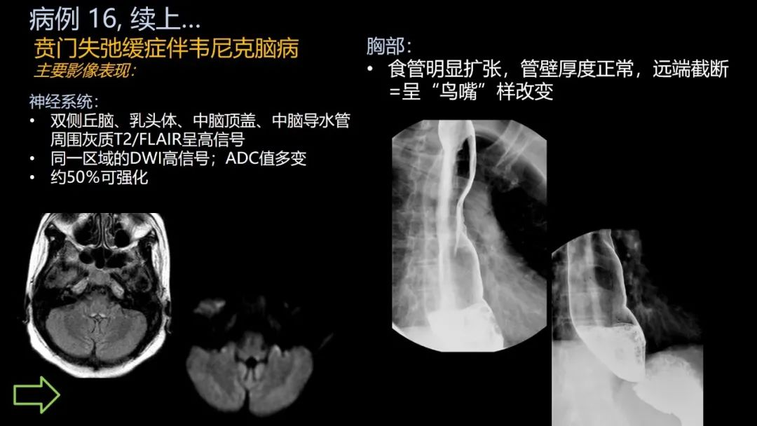 影像PPT - 【PPT】共通之处:同时累及中枢神经系统和心肺系统的疾病-99 影像PPT - 【PPT】共通之处:同时累及中枢神经系统和心肺系统的疾病-99