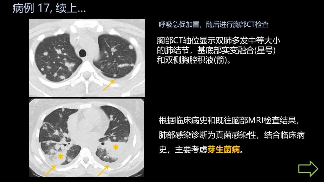 影像PPT - 【PPT】共通之处:同时累及中枢神经系统和心肺系统的疾病-103 影像PPT - 【PPT】共通之处:同时累及中枢神经系统和心肺系统的疾病-103