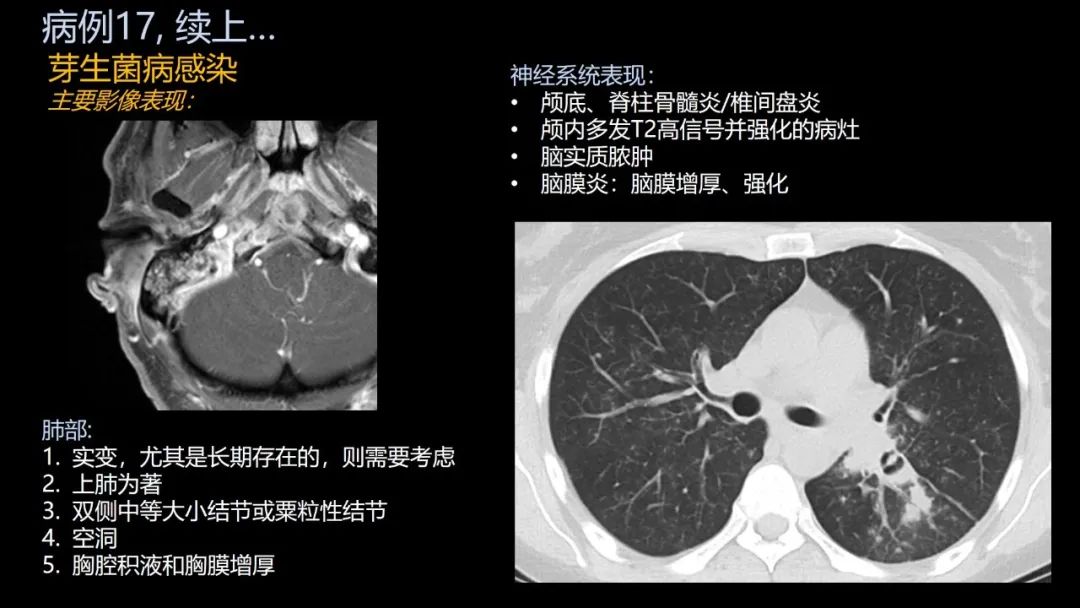 影像PPT - 【PPT】共通之处:同时累及中枢神经系统和心肺系统的疾病-105 影像PPT - 【PPT】共通之处:同时累及中枢神经系统和心肺系统的疾病-105