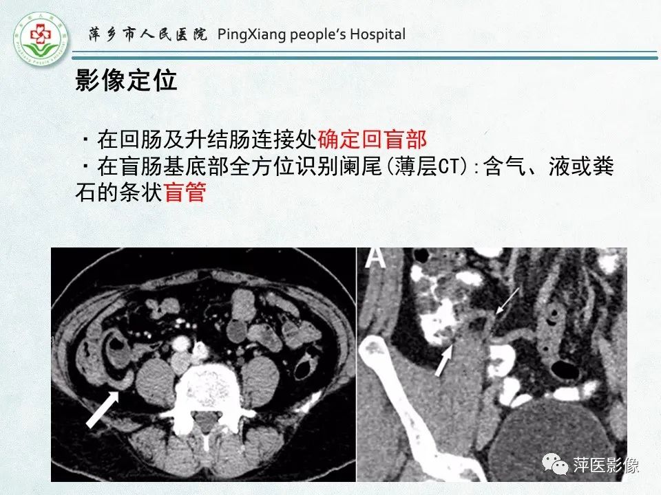 影像PPT - 【PPT】右下腹相关炎性病变-5