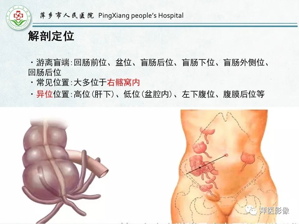 影像PPT - 【PPT】右下腹相关炎性病变-4