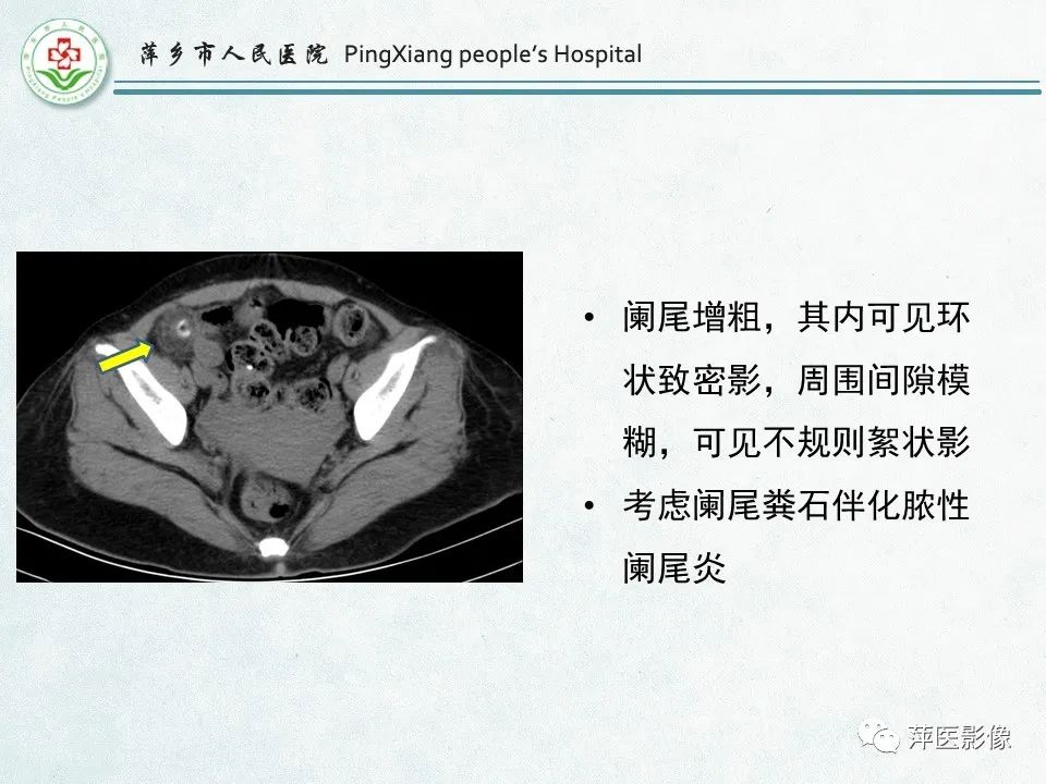 影像PPT - 【PPT】右下腹相关炎性病变-16