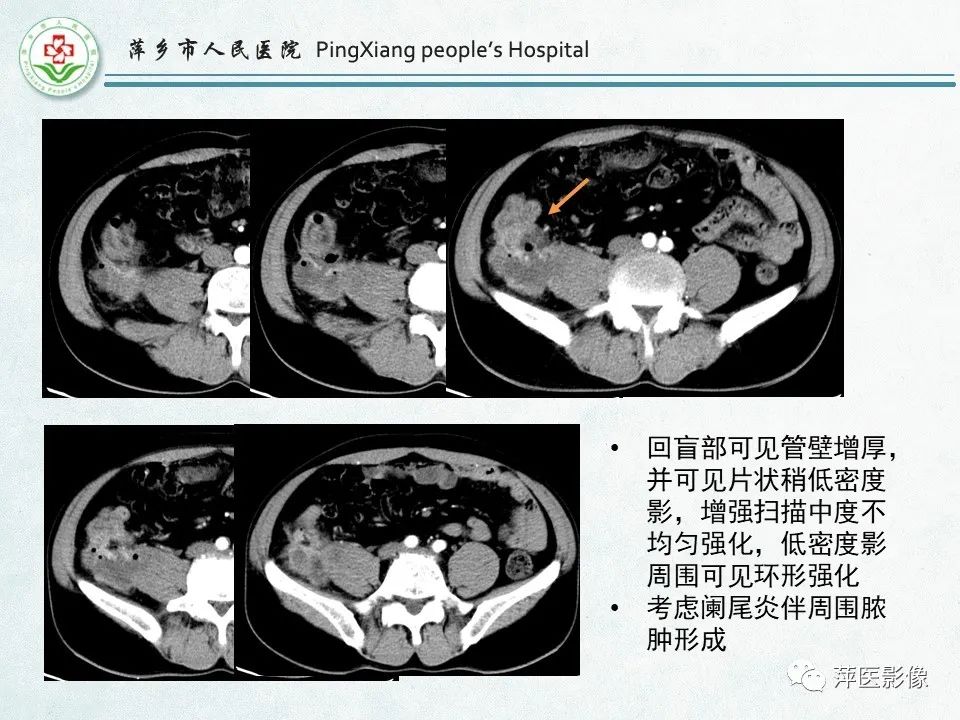 影像PPT - 【PPT】右下腹相关炎性病变-20