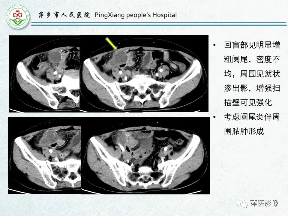 影像PPT - 【PPT】右下腹相关炎性病变-21