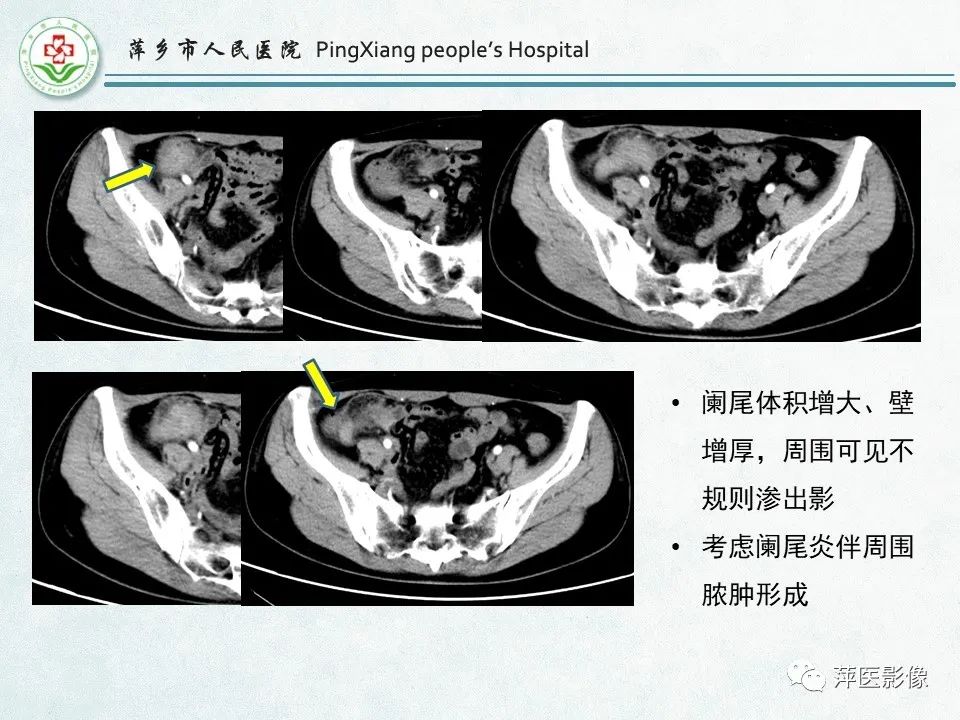 影像PPT - 【PPT】右下腹相关炎性病变-19
