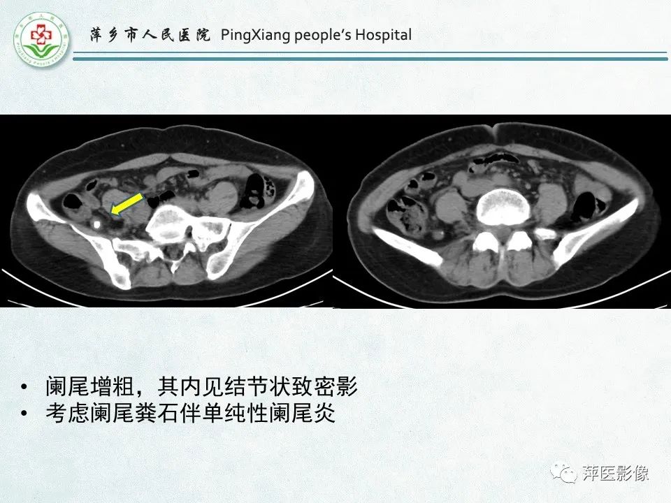 影像PPT - 【PPT】右下腹相关炎性病变-14