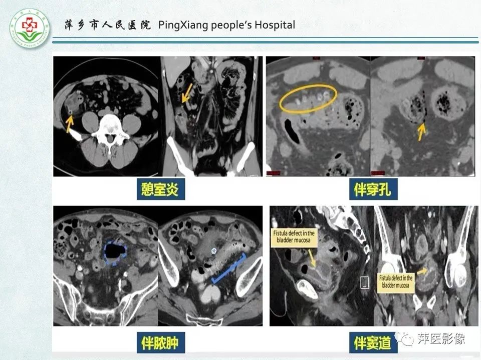影像PPT - 【PPT】右下腹相关炎性病变-30