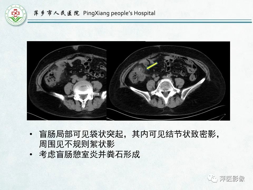 影像PPT - 【PPT】右下腹相关炎性病变-36