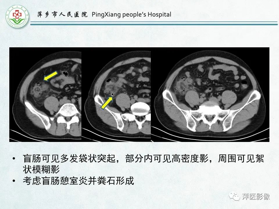 影像PPT - 【PPT】右下腹相关炎性病变-34