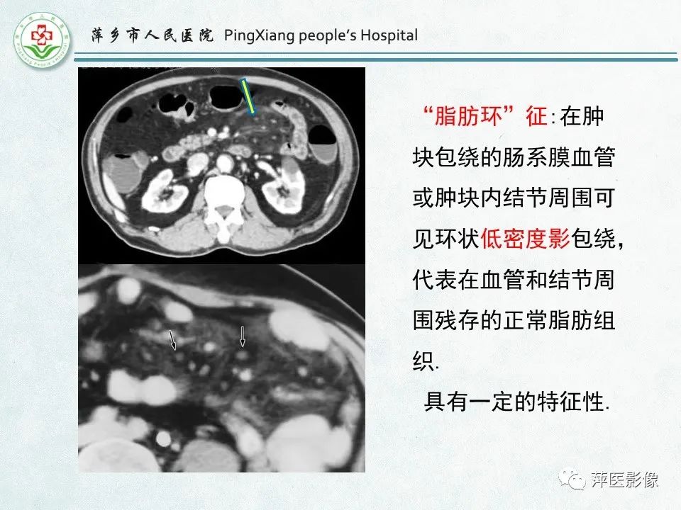 影像PPT - 【PPT】右下腹相关炎性病变-44