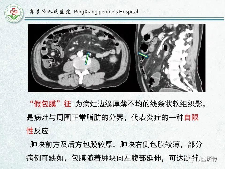 影像PPT - 【PPT】右下腹相关炎性病变-45
