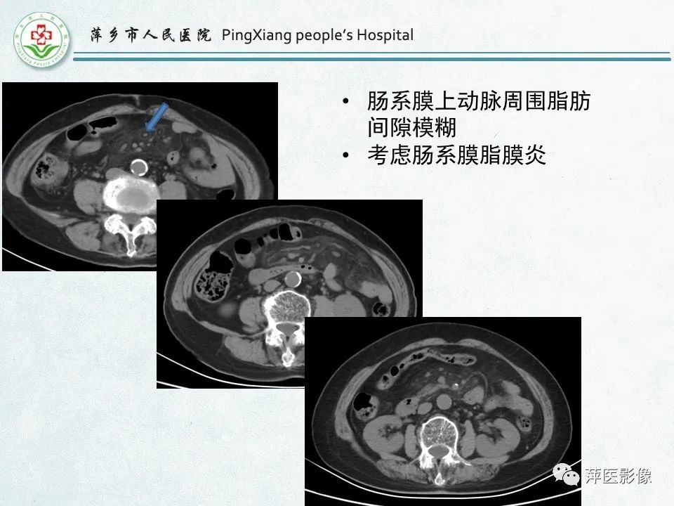 影像PPT - 【PPT】右下腹相关炎性病变-53