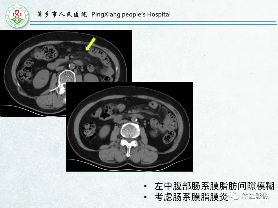影像PPT - 【PPT】右下腹相关炎性病变-52