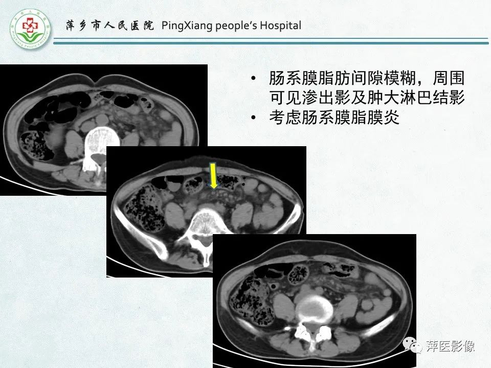 影像PPT - 【PPT】右下腹相关炎性病变-54