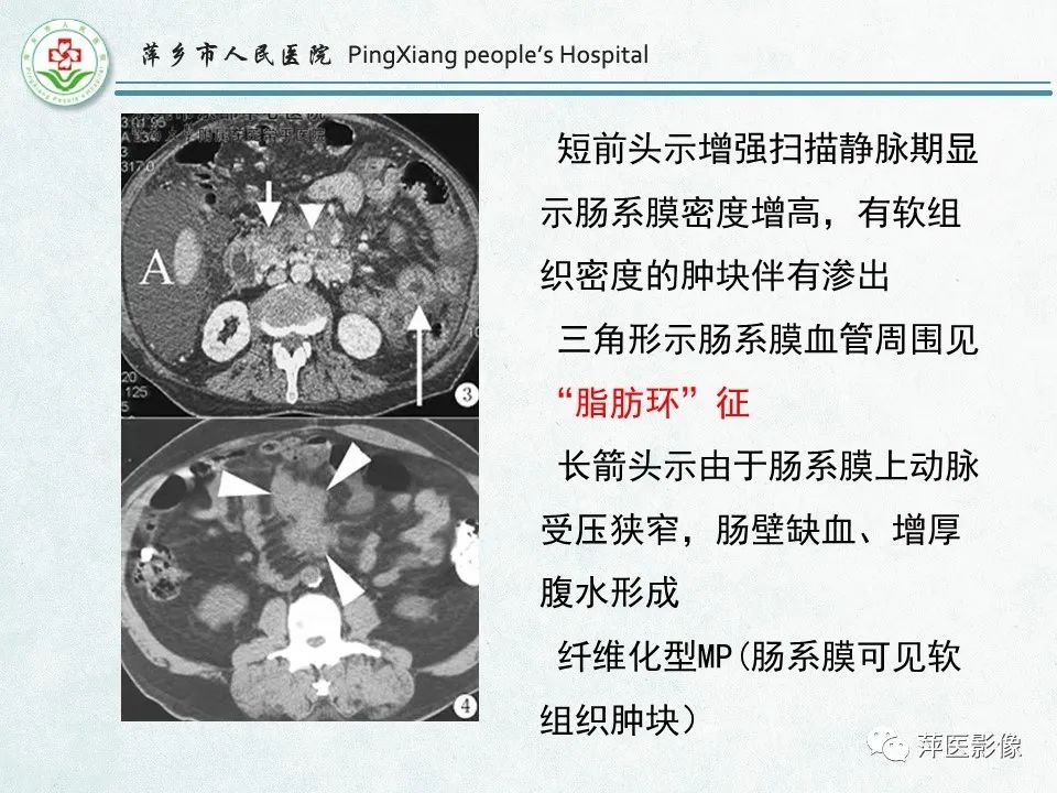 影像PPT - 【PPT】右下腹相关炎性病变-49
