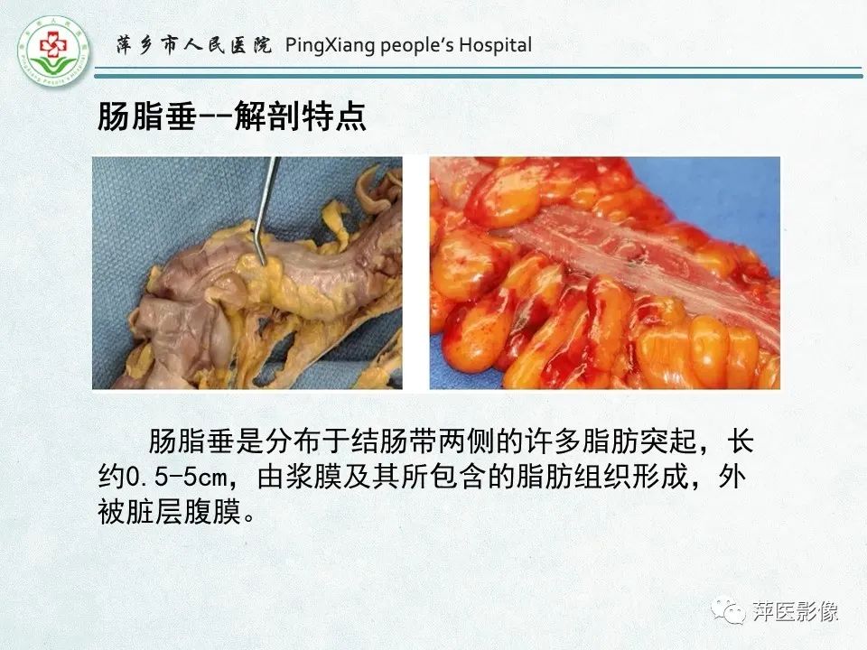 影像PPT - 【PPT】右下腹相关炎性病变-56