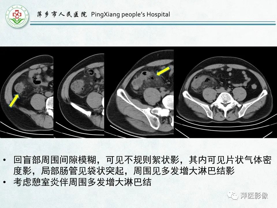 影像PPT - 【PPT】右下腹相关炎性病变-35
